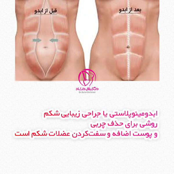 ابدومینوپلاستی چیست؟